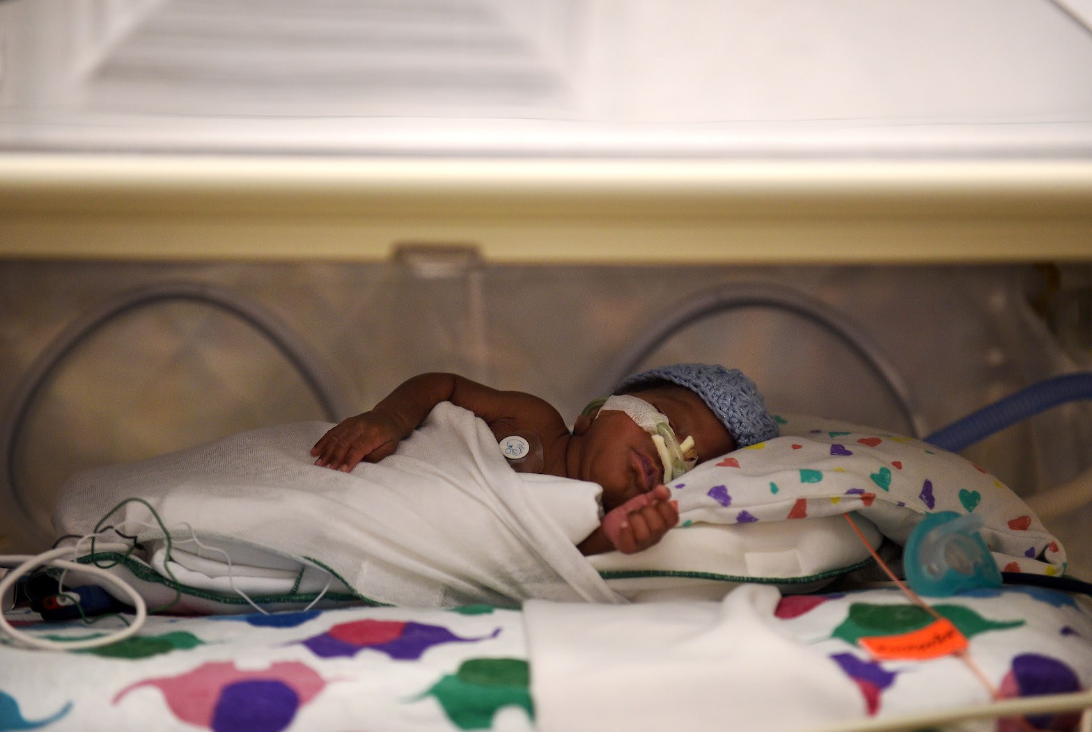 Breast milk is fed via tubes to a preterm infant at a neonatal intensive care unit.