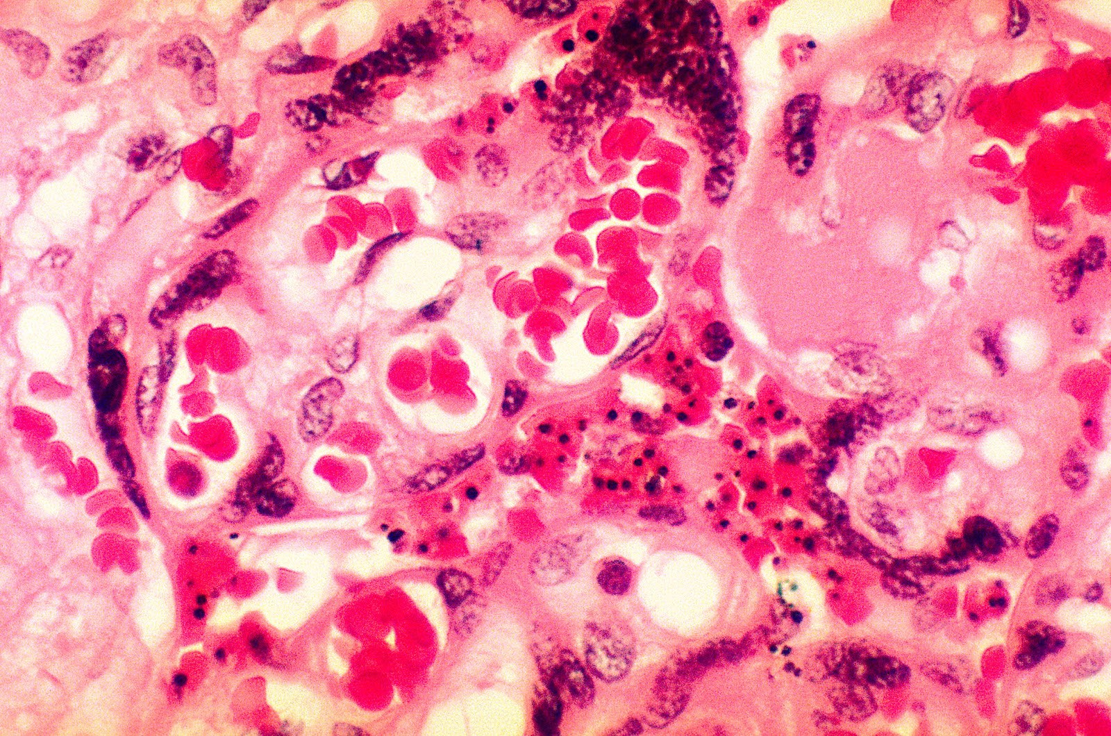 A photomicrograph of placental tissue revealing the presence of the malarial parasite Plasmodium falciparum. 