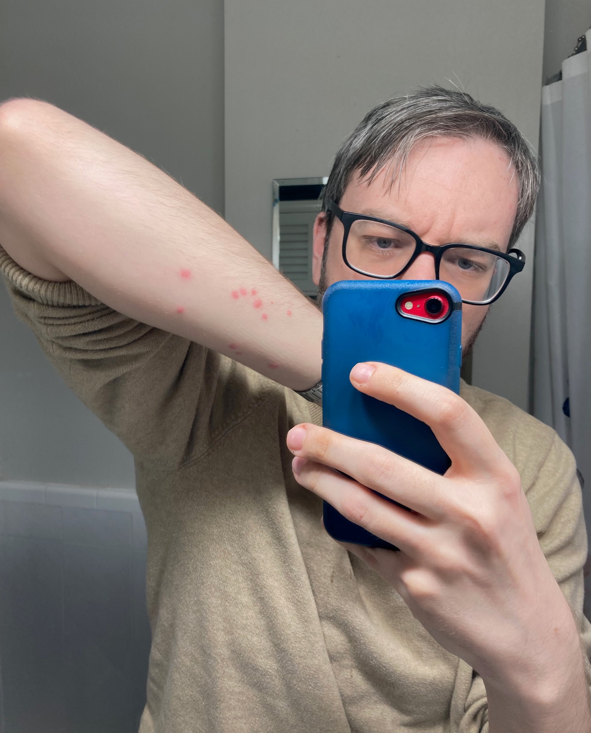 Author Dylan Matthews’s arm with very visible mosquito bites, shown in a mirror.