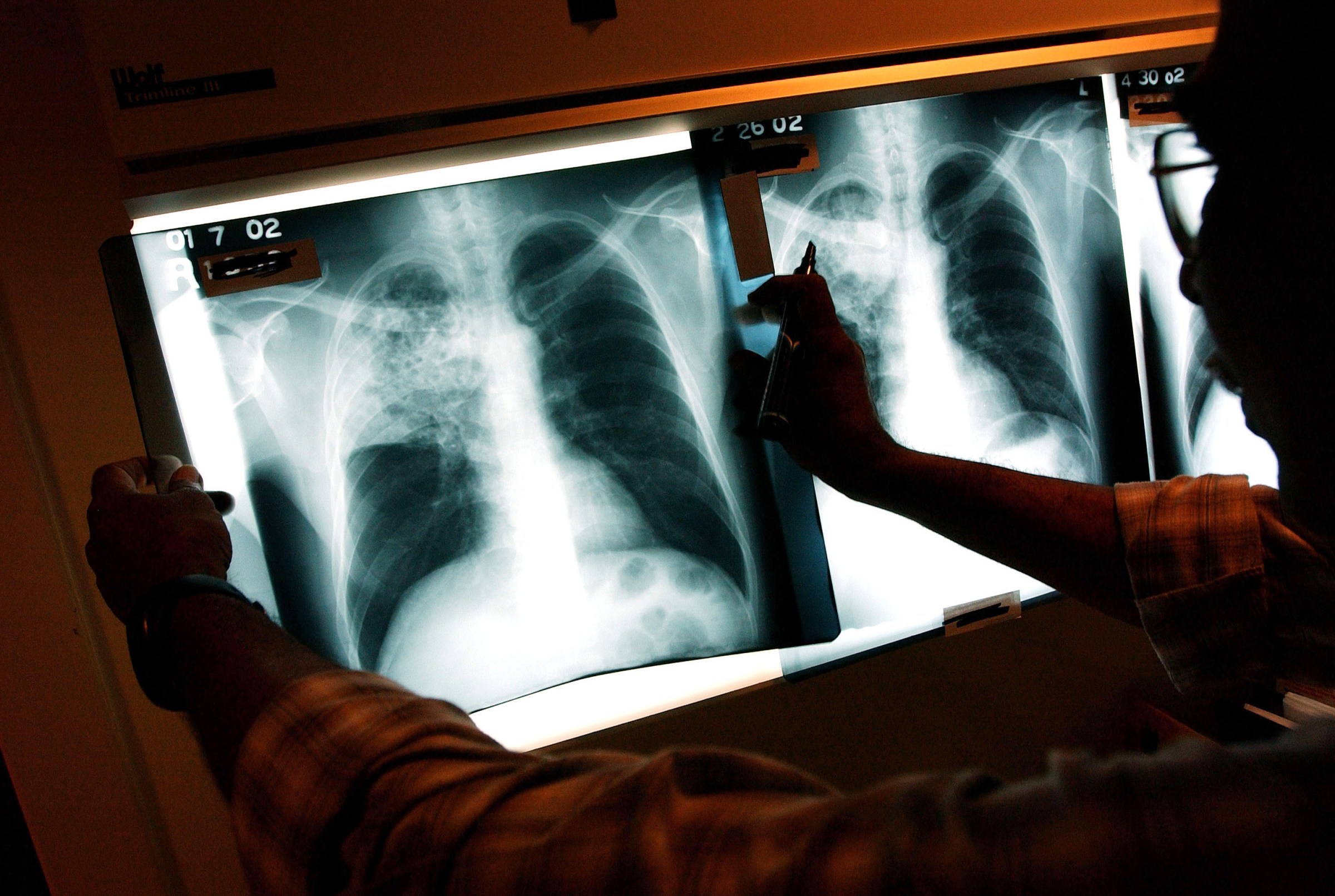 A doctor, in black silhouette in a dark room, examines several x-ray images of a person’s chest and lungs, which are brightly lit by a lightbox from behind.