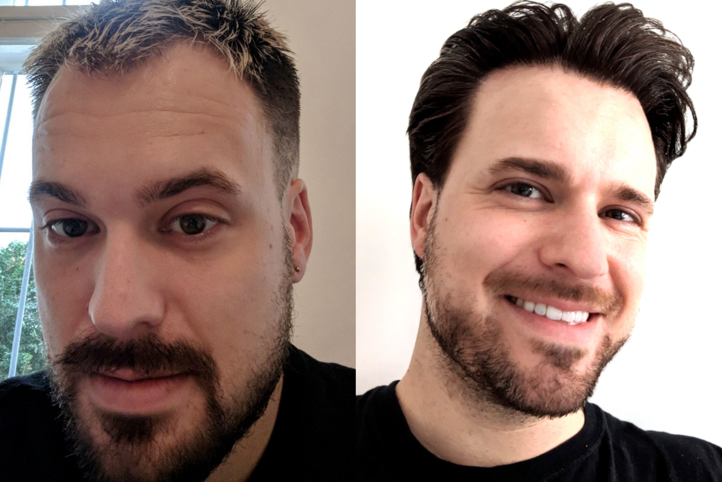 Adam Hurly’s hair before his hair transplant and after