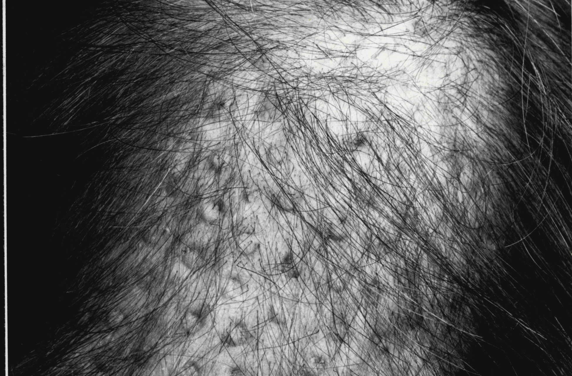 An unsettling close-up view of a scalp with thin hair, growing out of what looks like large bumps.