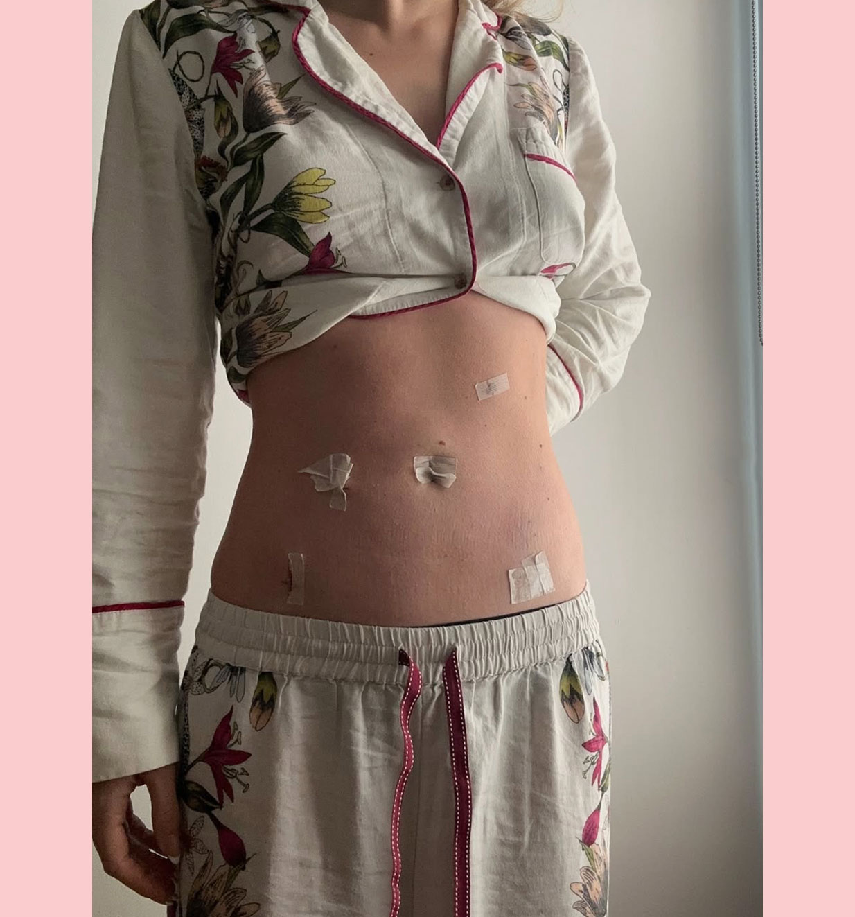 lili reinhart scars