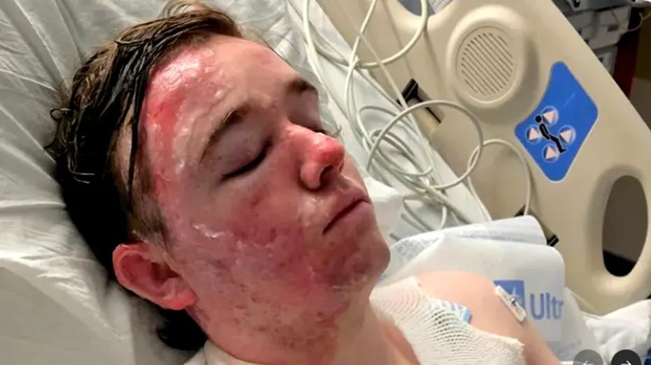 Jacob Smith lying in hospital bed with severe burns
