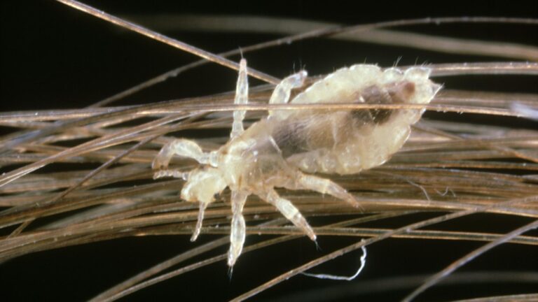 It's Head Lice Season. Here's What to Know