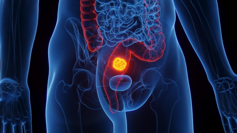Some Rectal Cancer Patients May Be Able to Skip Surgery, Chemo, and Radiation